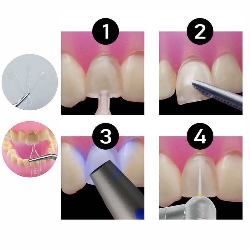 Set da 32 Pezzi di Stampi in R - Teeth Whitening Moulds recensione e prezzo