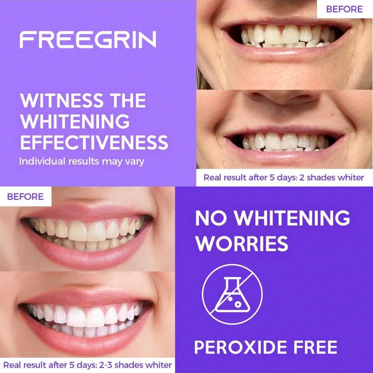 Adesivi sbiancanti per denti d - Teeth Whitening Near Me recensione e prezzo