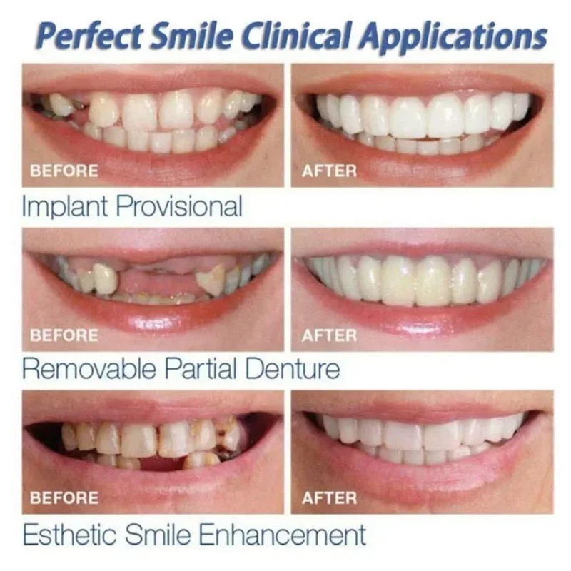 Kit di Denti in Impiallacciatu - Teeth Whitening Kit recensione e prezzo